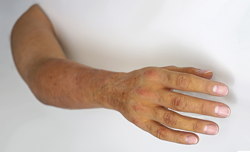 arm-prosthetics-custom