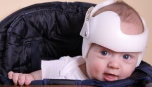 What Is a Cranial Helmet